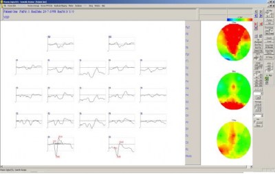 eeg-brain-1-1613740965